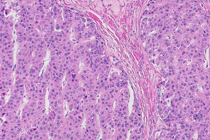 Fibrolamellar Tumor Cells