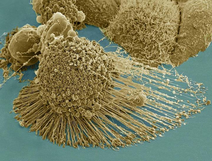 HeLa Cancer Cell in Apoptosis