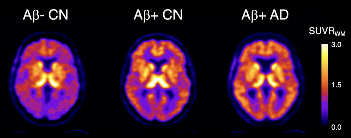 18F-SMBT-1 PET studies of beta-amyloid-positive Alzheimer’s disease patients