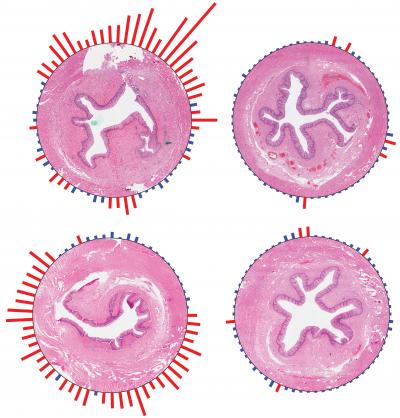 Eosinophilic Esophagitis