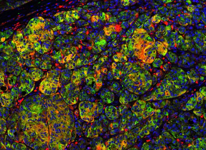 CPEB4, a Protein that Defines the Melanoma Blueprint