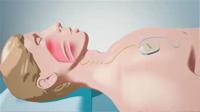 Inspire® Upper Airway Stimulation Therapy Video
