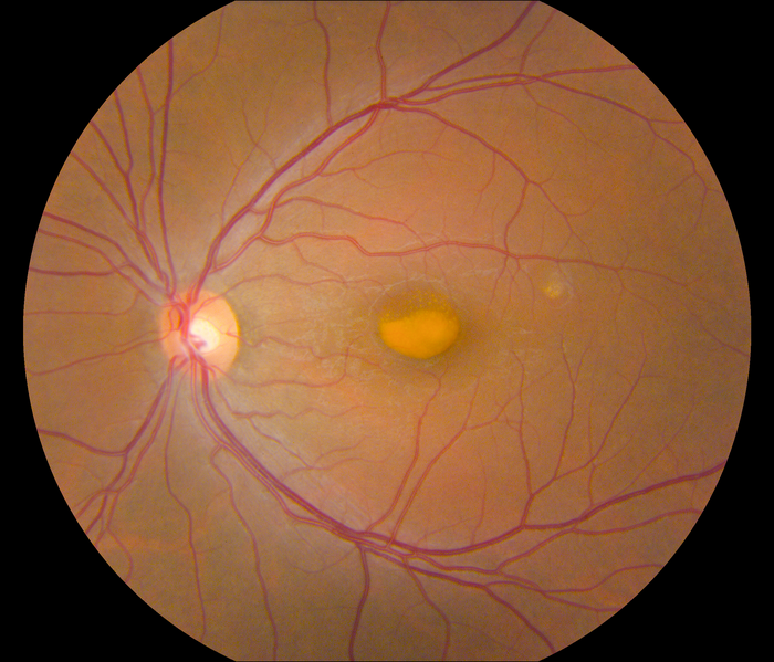 Retina with egg-yolk-like lesion in a person with vitelliform macular dystrophy