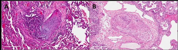 Hematoxilin-Eosin Staining of Human Formalin-Fixed and Paraffin-Embedded Lung Tissue