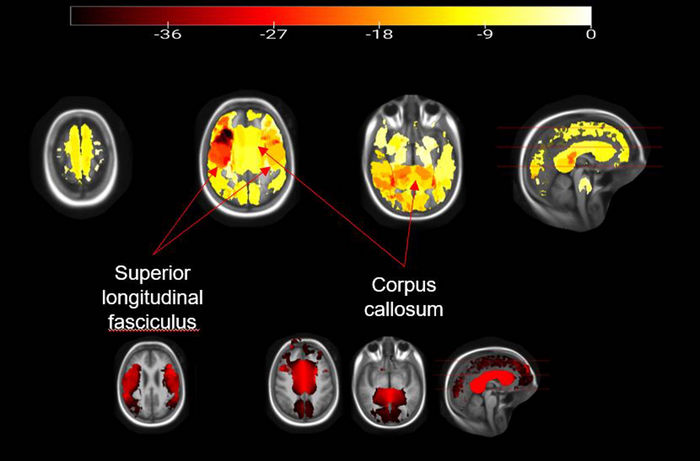 Obesity Linked to Poor Brain Health in Children