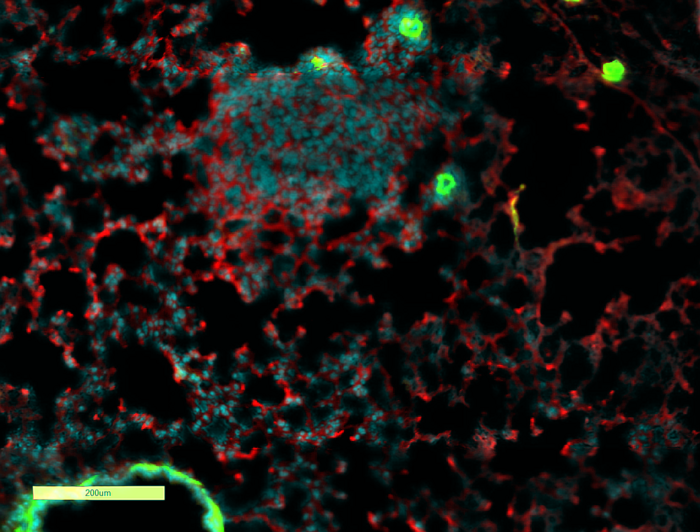 An image of lung with breast cancer metastasis, surrounded by inflammatory complement protein