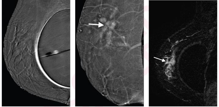 40-Year-Old Woman with Invasive Ductal Carcinoma of Right Breast