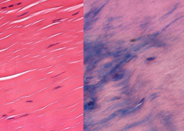 Searching for Better Treatments for Irritated Tendons