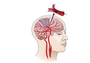 A Potential New Treatment for Stroke Patients