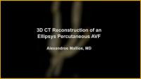 3D CT Reconstruction of an Ellipsys Percutaneous AVF