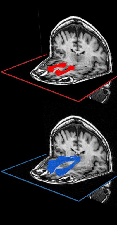 Brain Imaging Pinpoints White-Matter Pathways