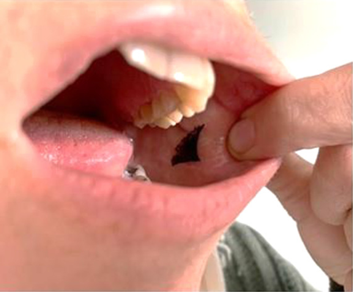 An insulin patch that sticks inside a person’s cheek