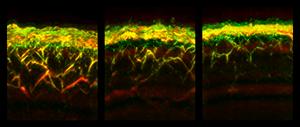 RSOM images of the skin of a healthy volunteer (left), a patient with diabetes (center) and a patient with neuropathy (right).