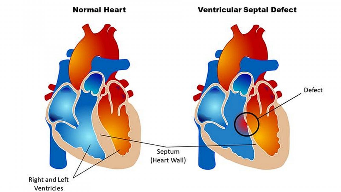 Normal Heart Vs. Heart with Defect