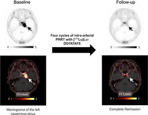 PET imaging of meningioma after radionuclide therapy.