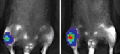 Researchers Urge Monitoring of Bone Health During Chemotherapy