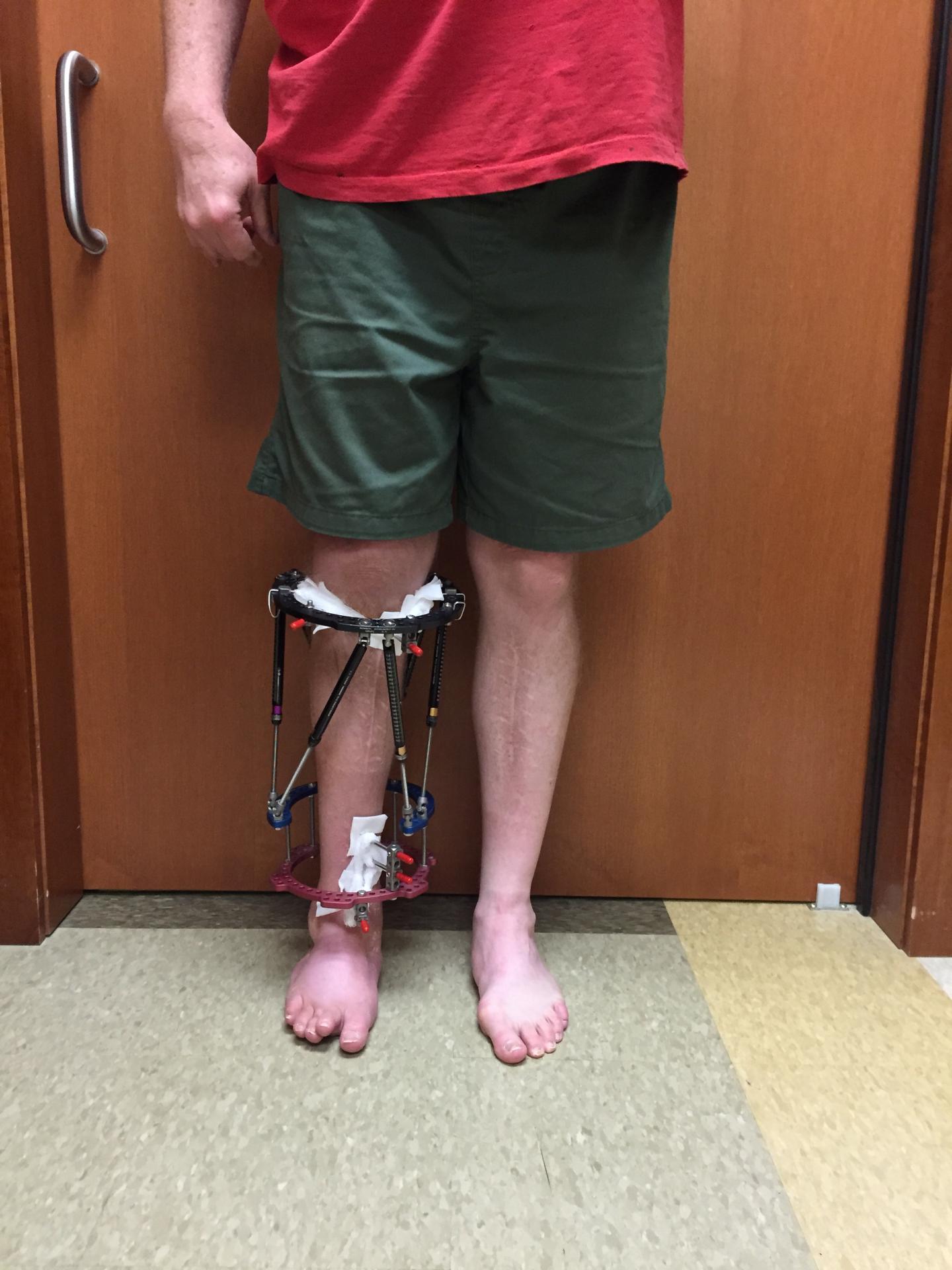 Standard Limb-Lengthening Technique