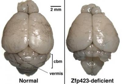 Malformed Cerebellum