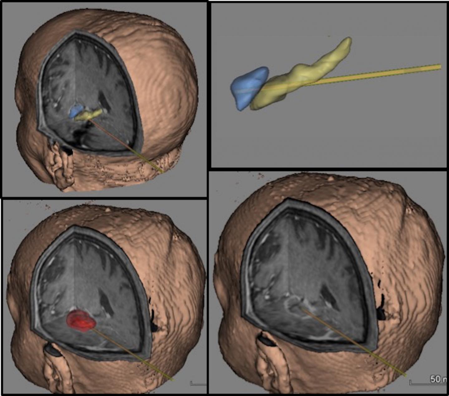 What's the Right Amount of 'Zapping' in Epilepsy Laser Surgery?