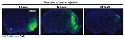 Brain Liquefaction After Stroke