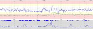 Cardiotocography (CTG) recording data