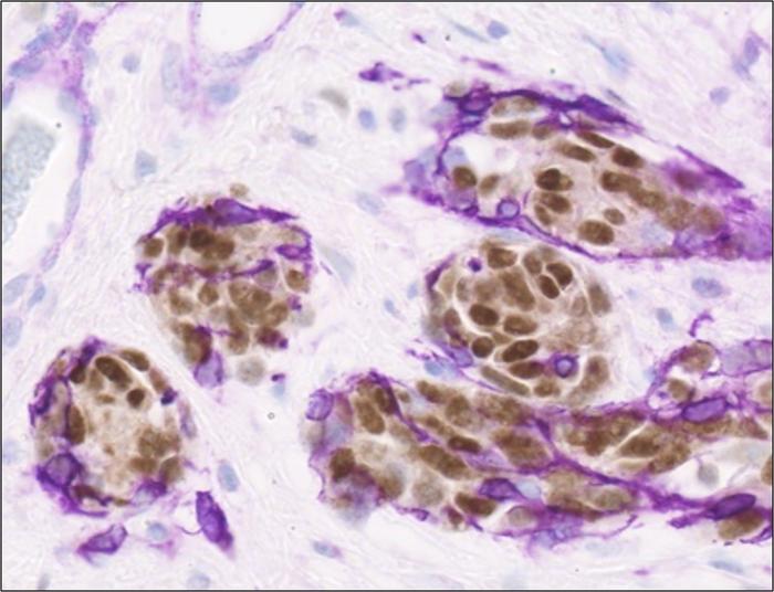 Metastatic melanoma cells