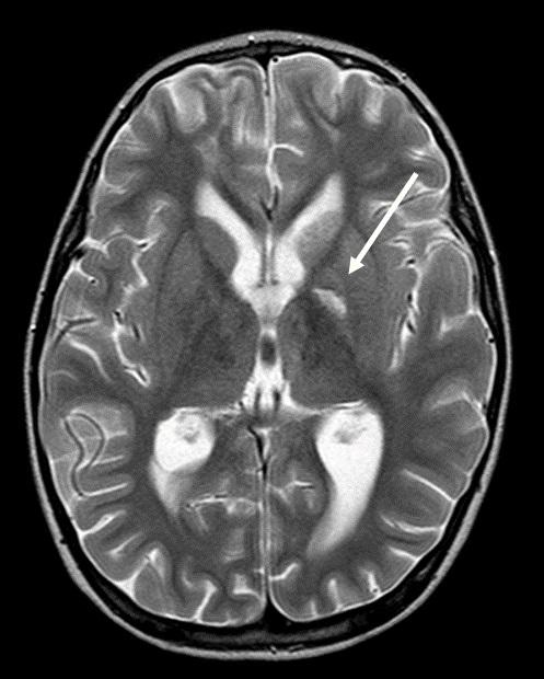 MRI Scan of Tuberculosis Meningitis Patient Reveals a Loss of Blood Supply to Part of the Brain