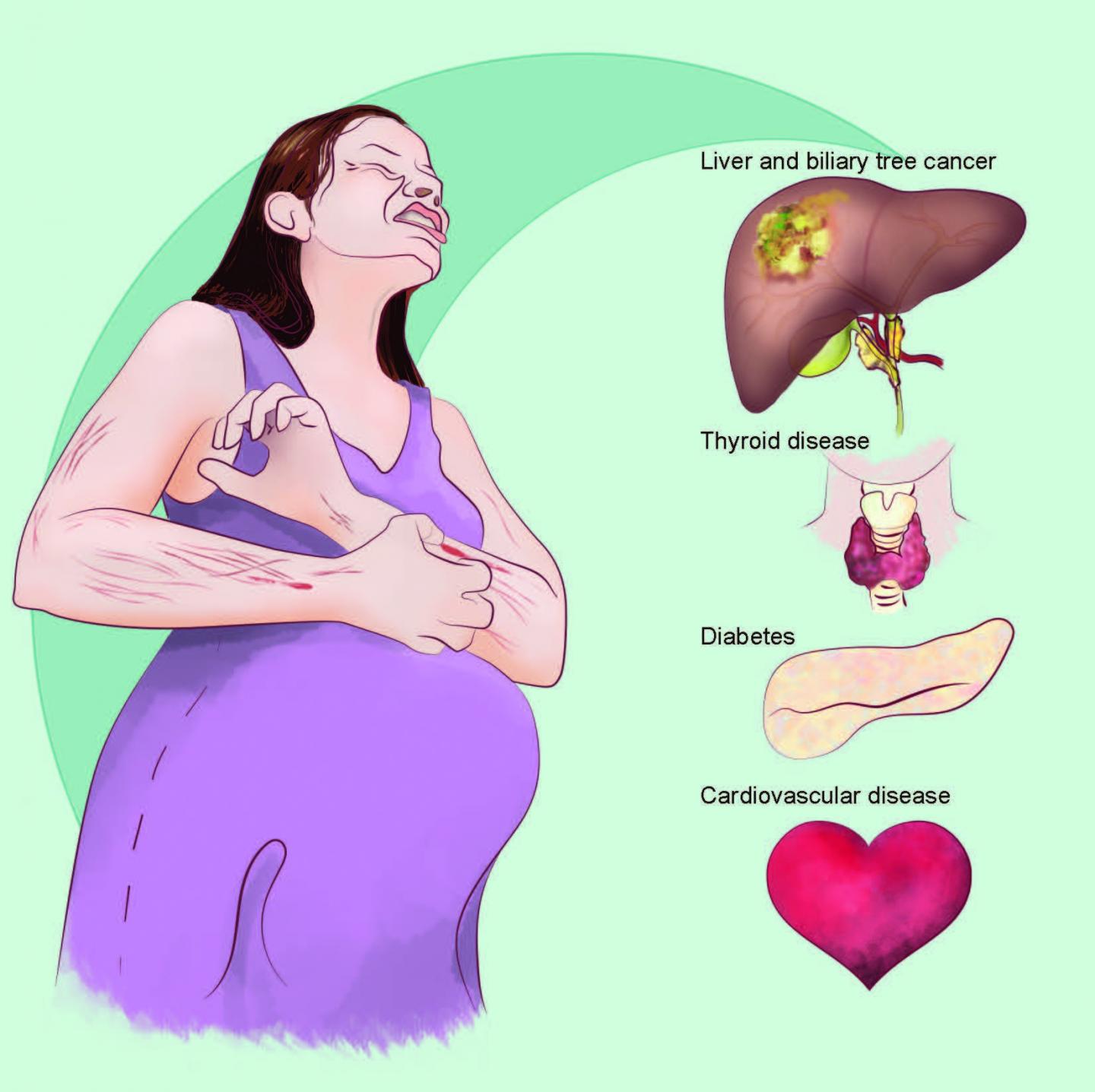 Research Links Intrahepatic Cholestasis of Pregnancy with  Liver Cancer and Other Diseases Later in Life