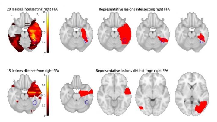 Lesions Causing Face Blindness after Stroke