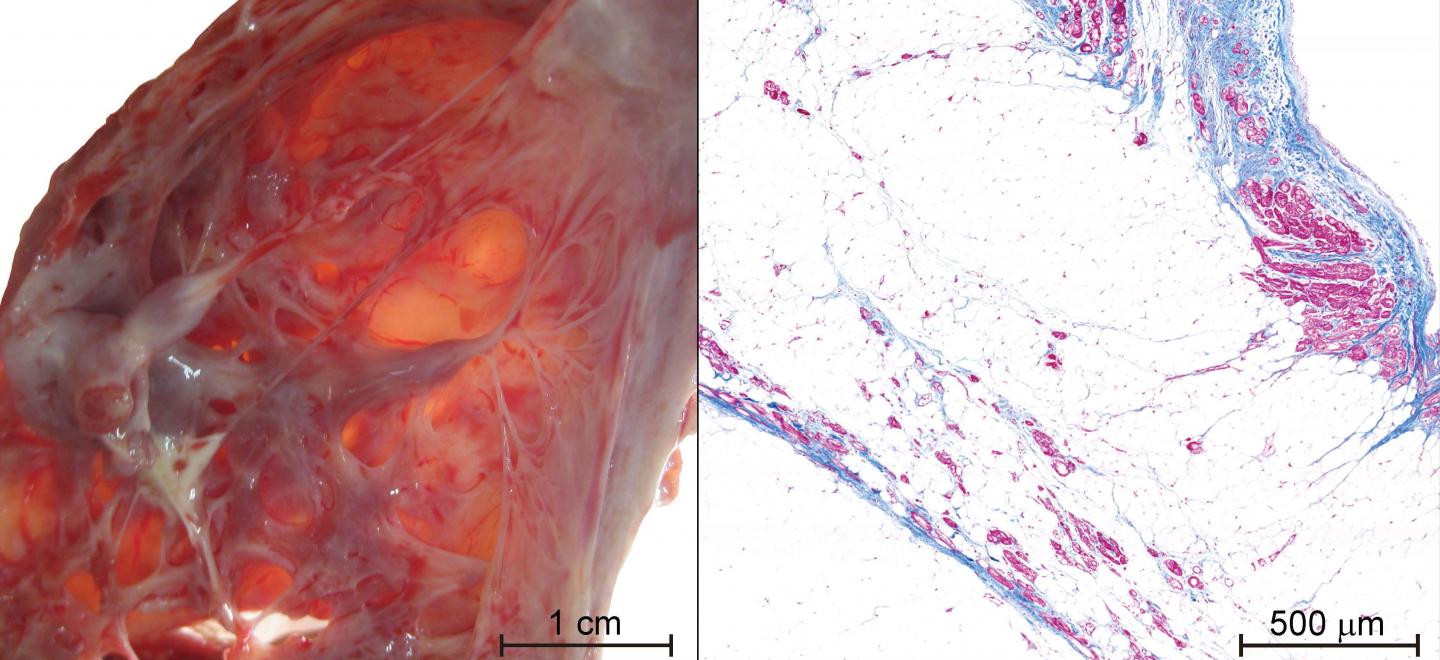 Tracking a Silent Killer: New Biomarker Identified for Arrhythmogenic Cardiomyopathy (1 of 1)