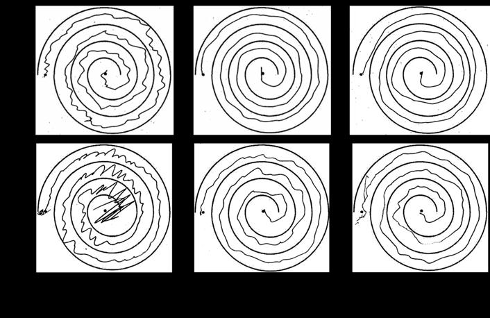 CSNE Closed-loop DBS System Spiral Drawing Results