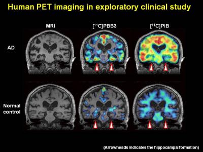 Human PET Imaging in Exploratory Clinical Study