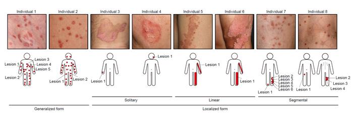 Kubo Keratosis Lesions