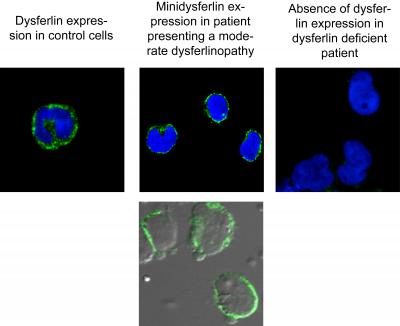 Big Steps for Mini-Genes in Muscular Dystrophy (2 of 6)