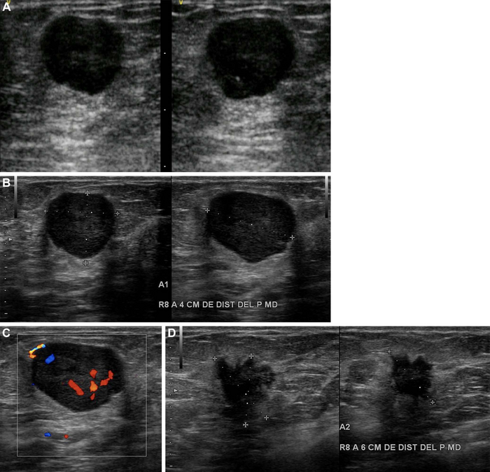 AI Helpful in Triaging Breast Masses in Low-Resource Areas