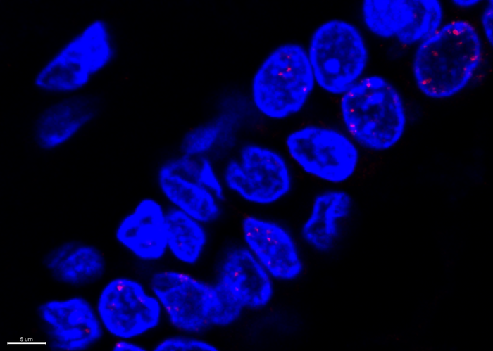 Damage to the DNA (red) in the nuclei (blue) of normal cells in the milk ducts of a BRCA mutation carrier was identified using immunofluorescence.