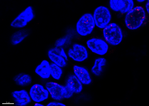 Damage to the DNA (red) in the nuclei (blue) of normal cells in the milk ducts of a BRCA mutation carrier was identified using immunofluorescence.