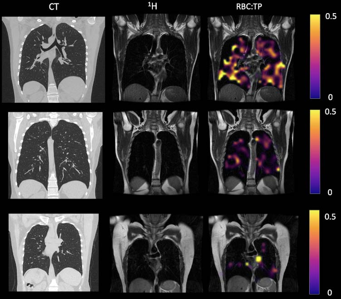 MRI Finds Lung Abnormalities in Non-Hospitalized Long COVID Patients