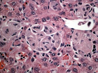 Liver in Type 1 Gaucher Disease