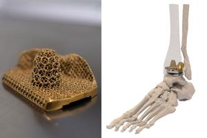 3D-printed ankle replacement and anatomic rendering