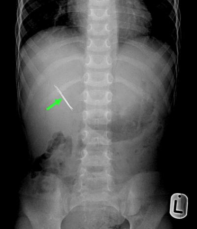 Abdominal X-ray