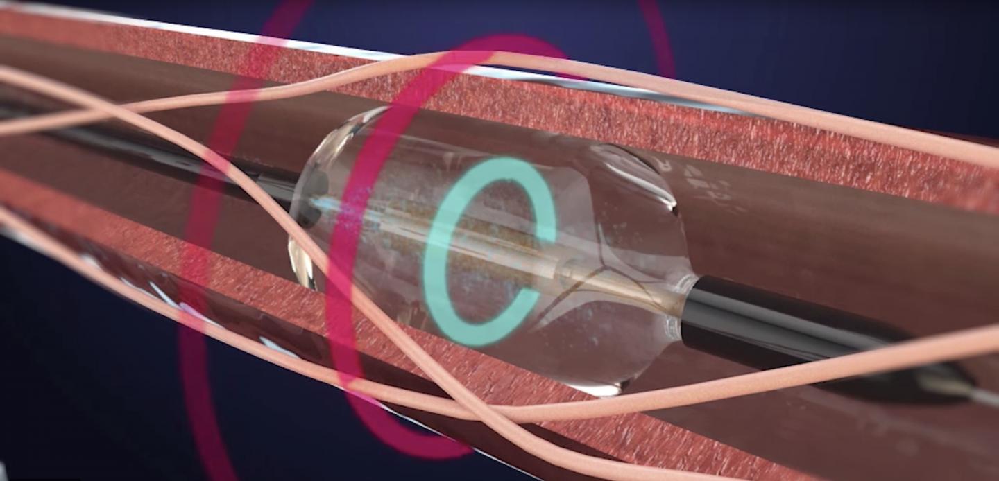 Renal Denervation System 2