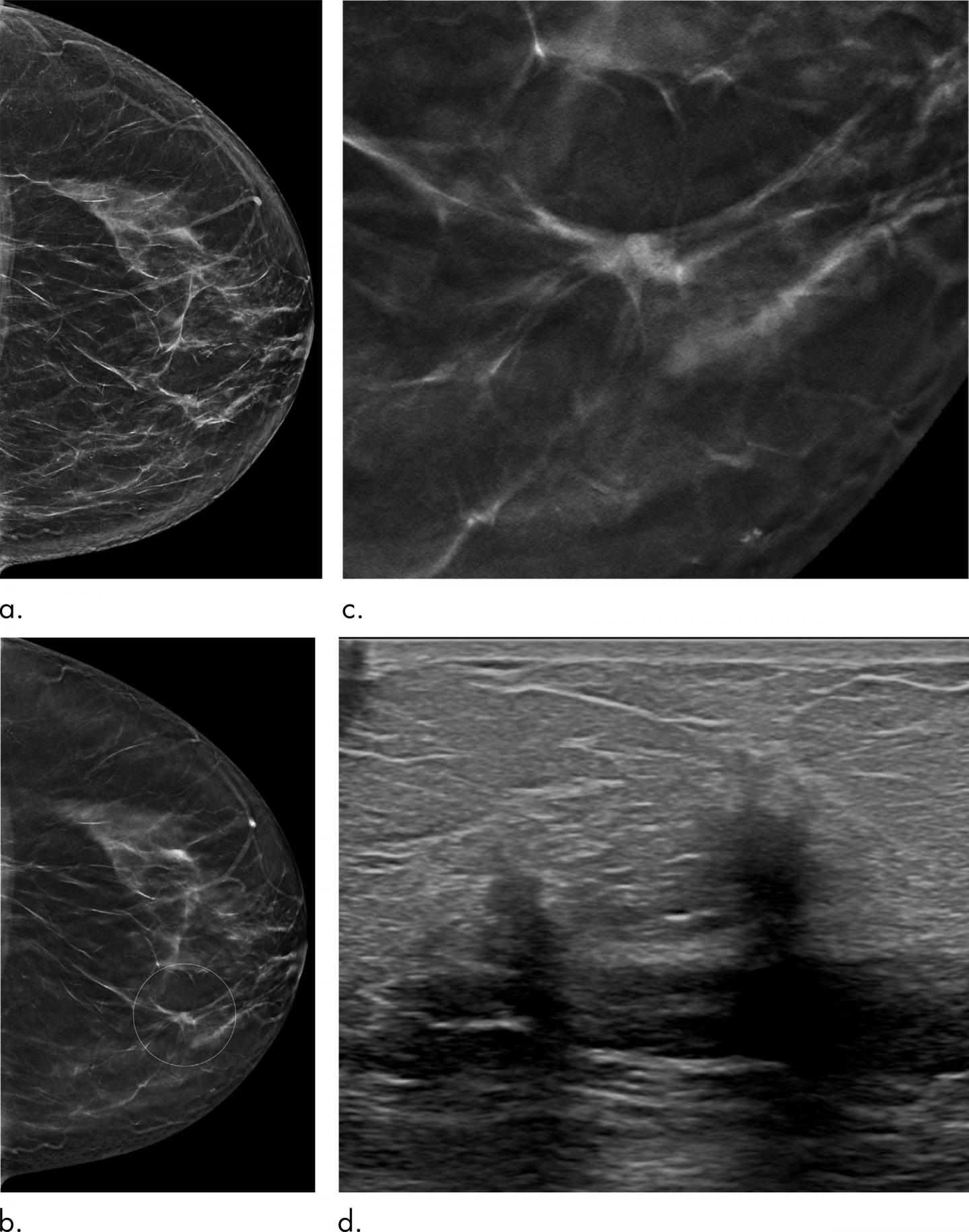 Breast cancer detection: advantage DBT •