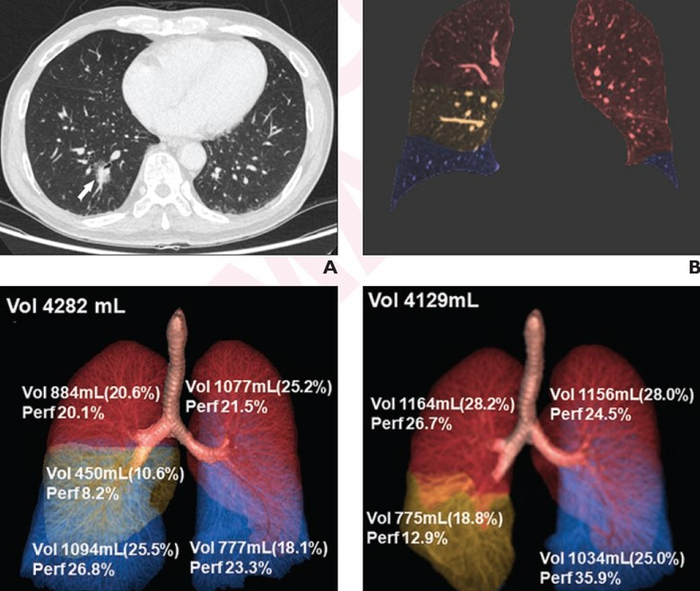 76-year-old male patient who underwent right lower lobectomy for lung cancer