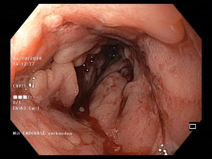 Colon with Crohn's Disease