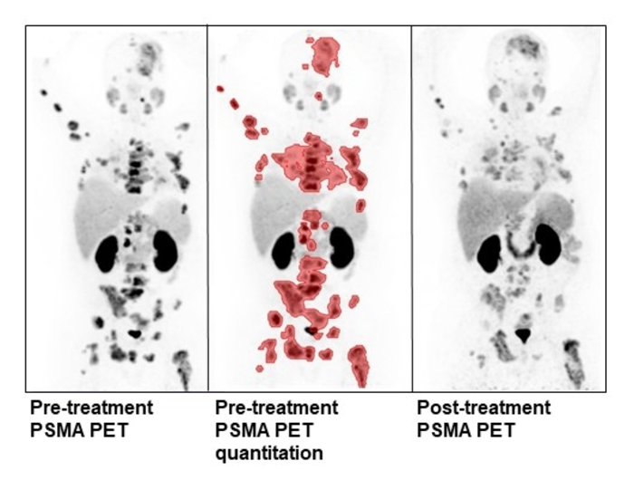 New radionuclide combination therapy safe and | EurekAlert!