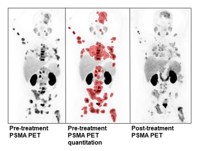 Quantitative analysis of pre-treatment PSMA PET/CT in a patient undergoing treatment with ¹⁷⁷Lutetium-PSMA-617/NOX66.
