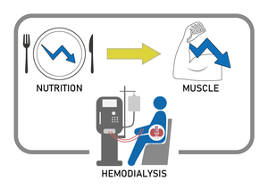 The Japanese Nutrition Risk Index (NRI) is used to examine the relationship between sarcopenia and malnutrition in MHD patients