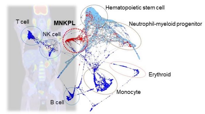 Extramedullary involvement of MNKPL and origin of MNKPL revealed by single cell RNA-Sequencing
