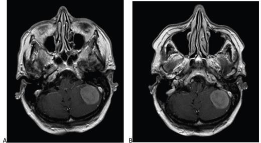 88-Year-Old Woman With Left Posterior Fossa Meningioma